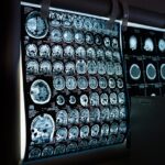Czy rezonans magnetyczny pokazuje nerwy?
